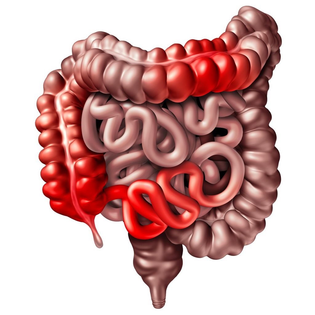 An illustration of the human intestines showing where Crohn's disease affects these organs.