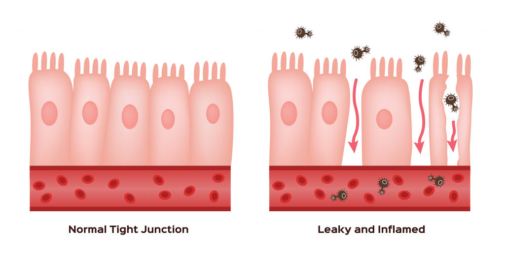 An illustration comparing the normal tight junctions of healthy villi versus leaky gut progression. 
