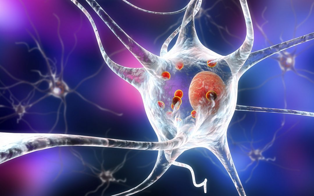 3D illustration showing neurons containing Lewy bodies small red spheres which are deposits of proteins accumulated in brain cells that cause their progressive degeneration in Parkinson's disease.
