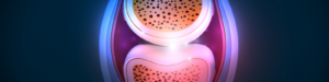 A computer-generated image showing a close-up of inflammation in a knee joint with synovial fluid highlighted.