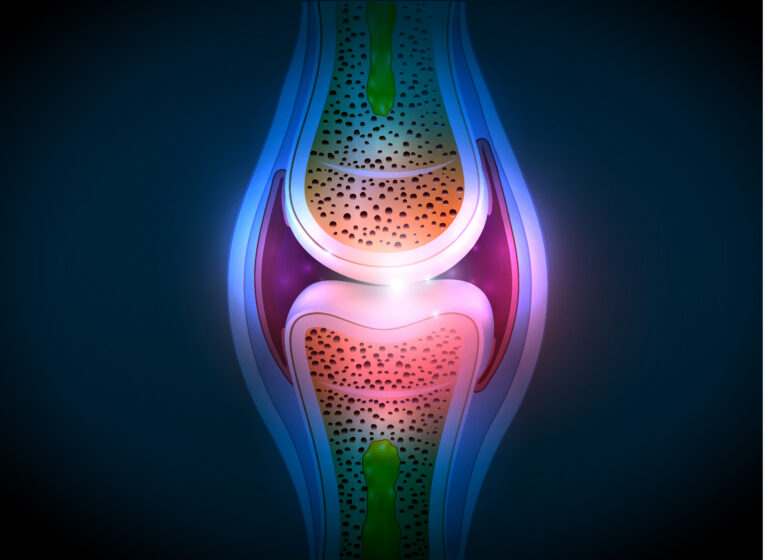 An illustration of a knee joint with synovial fluid inflammation which can be investigated through calprotectin mrp8/14 measurement.